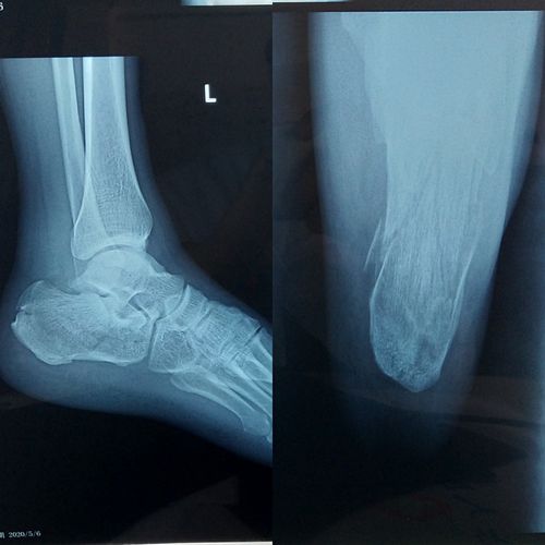 用我们自己的病例讲述外二科的故事——跟骨骨折微创内固定篇