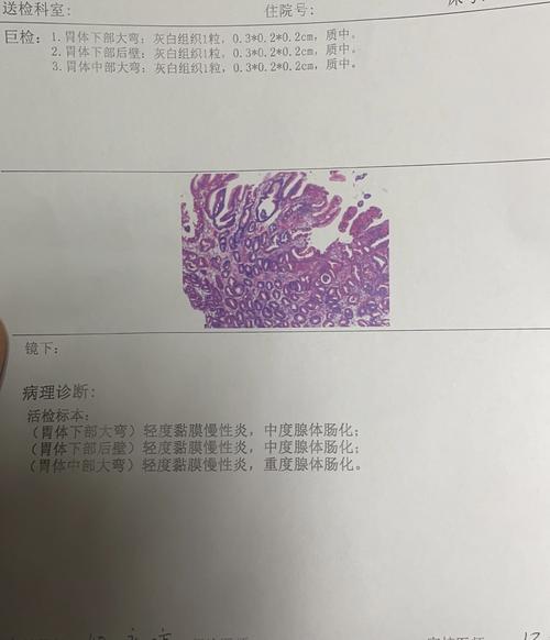 爸爸的胃镜病理报告,求求各位帮忙看看!
