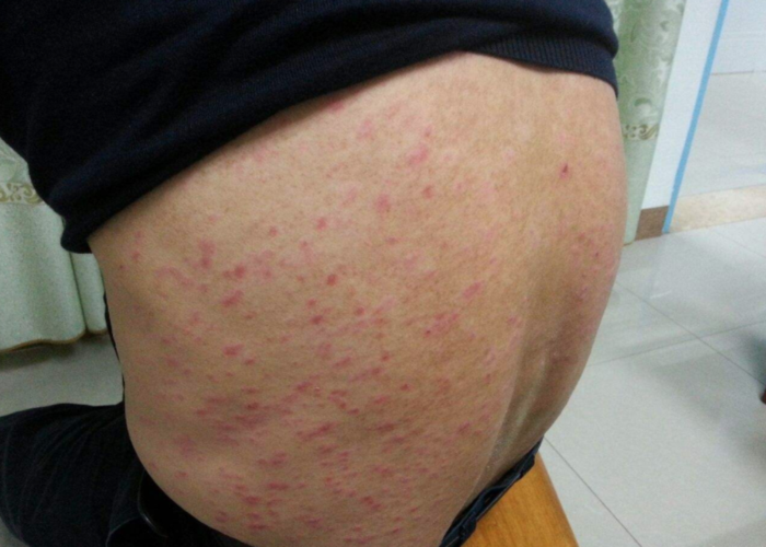 尤其是出汗后,汗液不能及时挥发,闷住会造成局部皮肤会出现红肿和汗斑