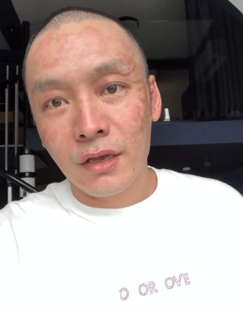 徐真真烧伤一个月后终出院,剃光头脸部满是疤痕,外形大变认不出