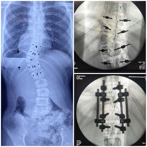病例分享 – - 先天性脊柱侧弯 t11半椎体畸形