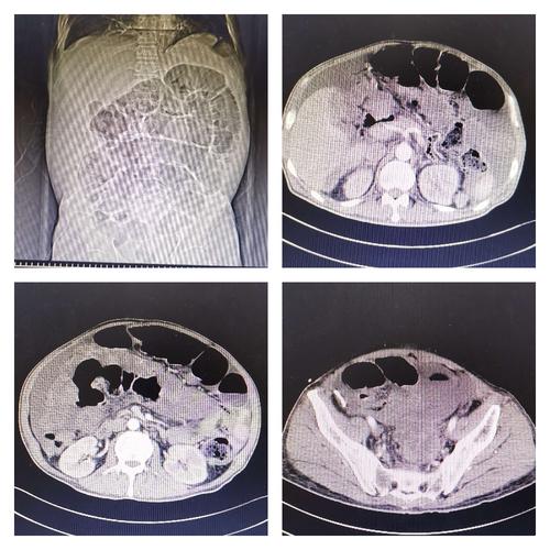 全腹部增强ct提示肠梗阻,乙状结肠吻合口肿瘤复发