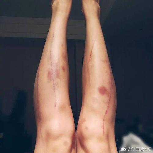 傅园慧自残?"洪荒少女"为比赛自虐成瘾,满臂抓痕惹人心疼
