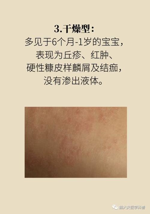 宝宝湿疹总好不了?原来是这几点没做对