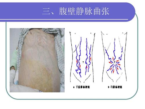 三,腹壁静脉曲张