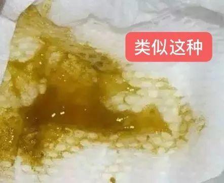 正常情况下大便中都带有一定粘液,因为很少所以肉眼看不出来.