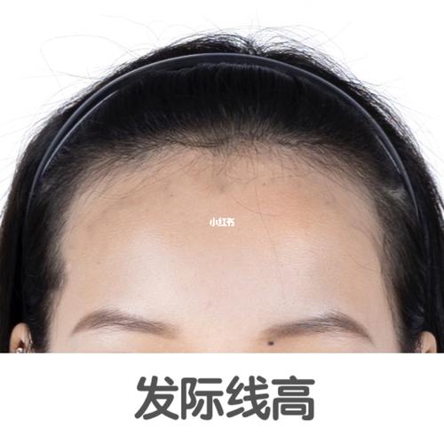 发际线_谁敢自曝发