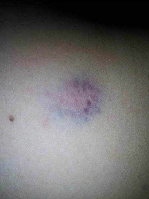 问:我妈腿上有时候会有这样的淤血,过一段又好了,什么情况