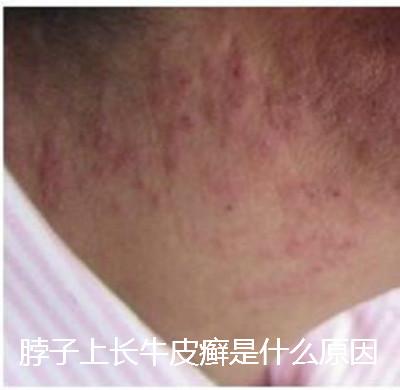 安庆潜山县什么是银屑病安庆潜山县神经性皮炎怎么治疗