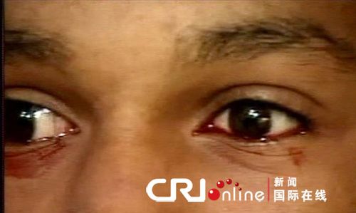 "血泪少年"眼睛流血不流泪
