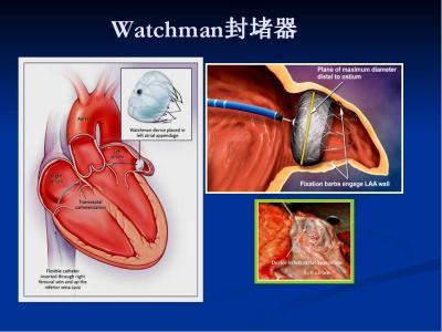 左心耳封堵术的watchman适应症