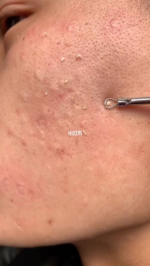 闭口粉刺_闭口粉刺_去闭口_脓包痘痘_怎么才能去闭口