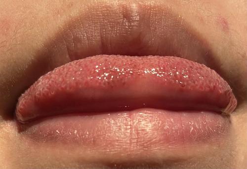 请问这个是口腔感染hpv的状态吗