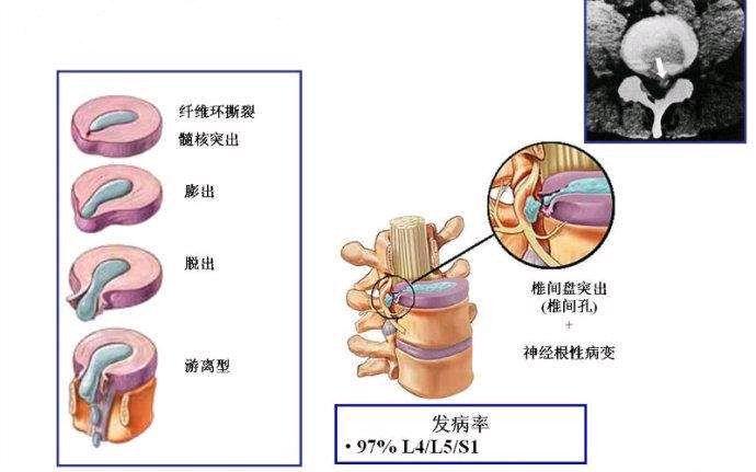 什么是椎间盘突出膨出脱出游离怎样治疗最好