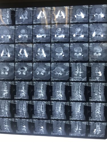 二骨二区,41床.张穗英,女,69岁,t12椎体压缩性骨折