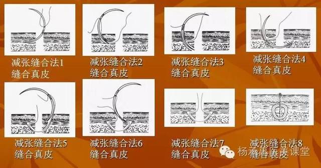 此方法也是三种主要埋没导引缝合基本技术之二