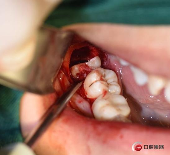 一次性微创拔除阻生智齿