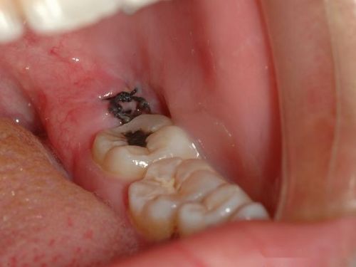 干槽症究竟有多可怕?