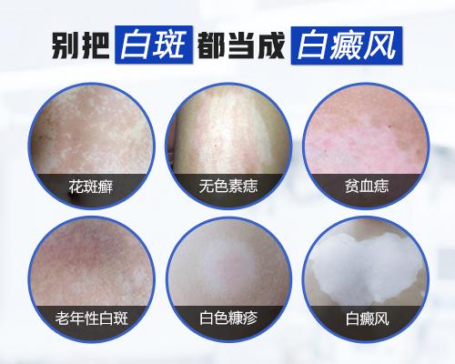 1,白斑会是白癜风吗