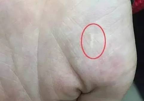 但我们的关注点在 比起被坑更为严重的 「疳积手术」 有中医认为,患有