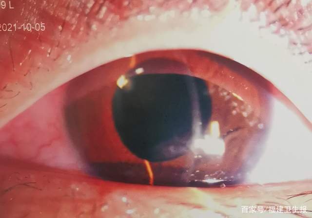 术后 有研究调查显示,因眼外伤导致的白内障占儿童白内