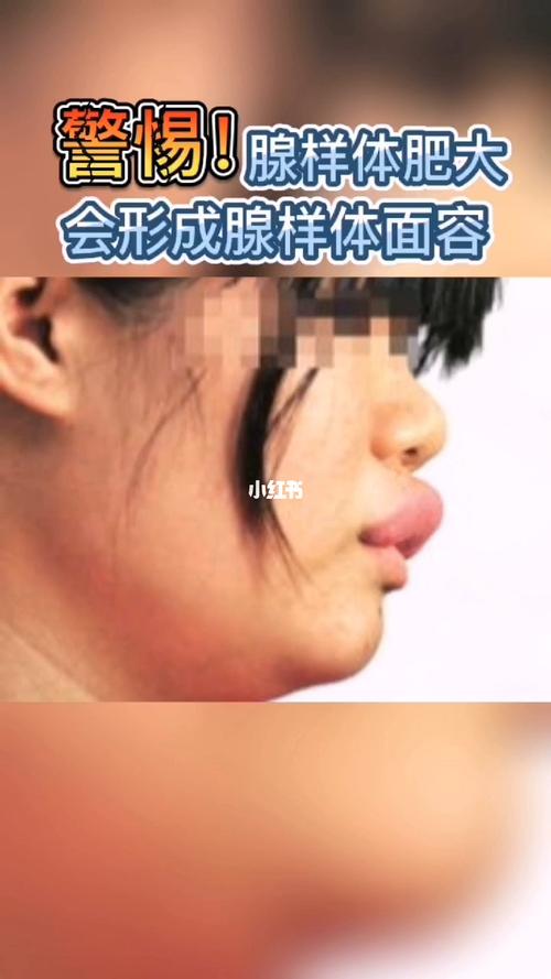 腺样体肥大形成腺样体面容_腺样体_腺样体肥大_母婴