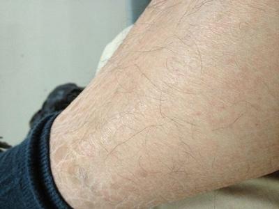 皮肤科 鱼鳞病 饮食  1,先天性大疱性鱼鳞病样红皮病:致病基因与角