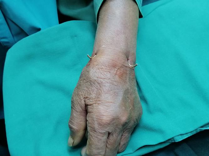 腕关节克氏针固定大体像.