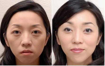 自体脂肪丰苹果肌安全吗