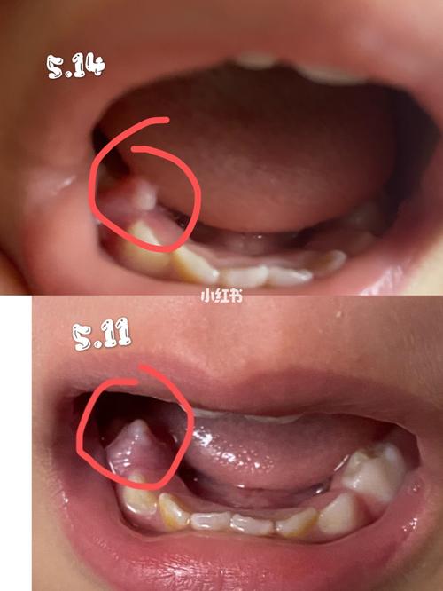 宝宝长牙牙龈有个小肉芽,求助啦_宝宝长牙_母婴_育儿