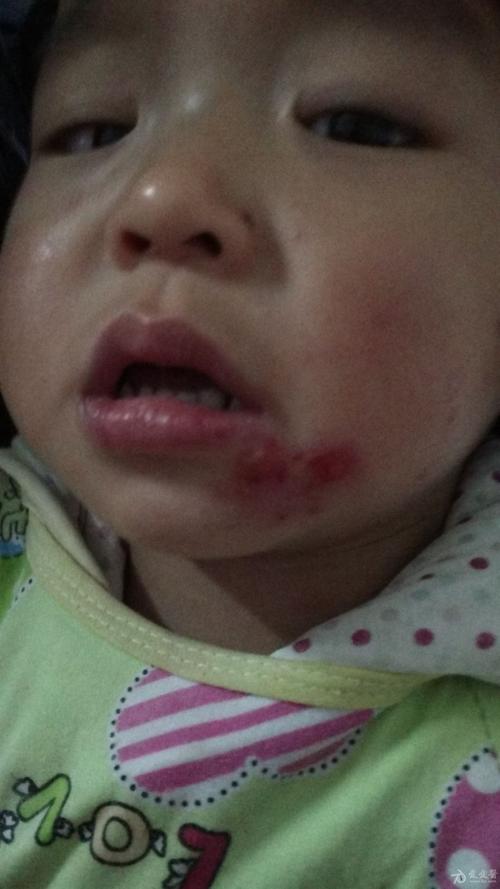 图 - 皮肤及性传播疾病讨论版 - 爱爱医医学论坛