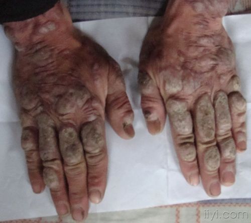 疑难的皮肤病例请教各位高手不胜感激