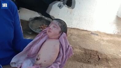 印度女子生下世界罕见女婴没有四肢整个人看着像海豹