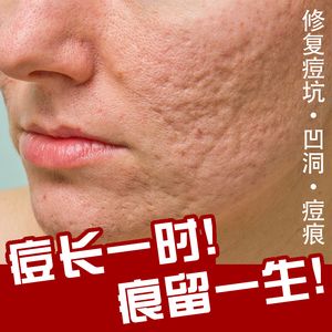 祛痘印痘坑除痘疤去凹洞去痘坑修复男士填充再生果酸淡化痘印女男