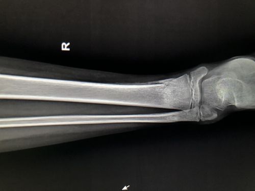 一个月骨痂生长