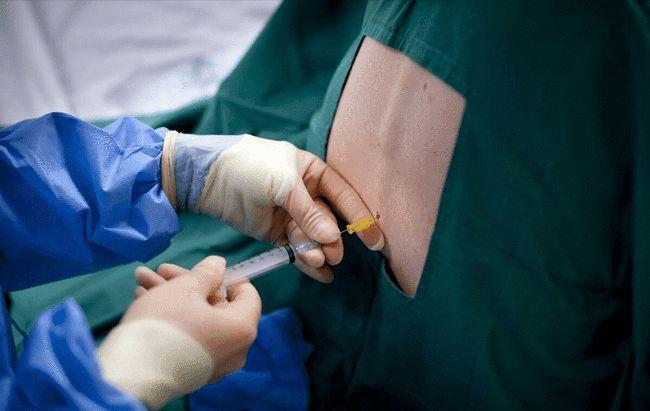 一次剖腹产,需要用到哪些工具?看着就痛,但不少孕妈仍