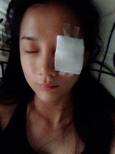 今年4月眼睛做完激光手术,但是老是感觉右眼眼角里有东西,很疼,很不
