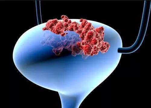 可怕的膀胱癌!那么哪些致癌物导致膀胱癌?
