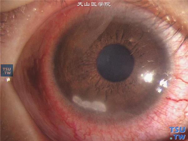 细菌性角膜炎(最详症状图解)