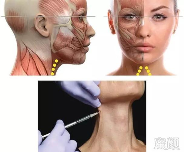 注射a型肉毒毒素改善颈阔肌/下颌轮廓,每侧注射6点,"圆点"代表1/3