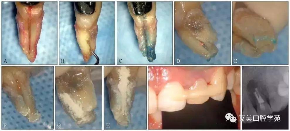 出22牙,显微镜下见22牙腭侧近中颈部自舌隆突向根方延伸至根尖部凹陷