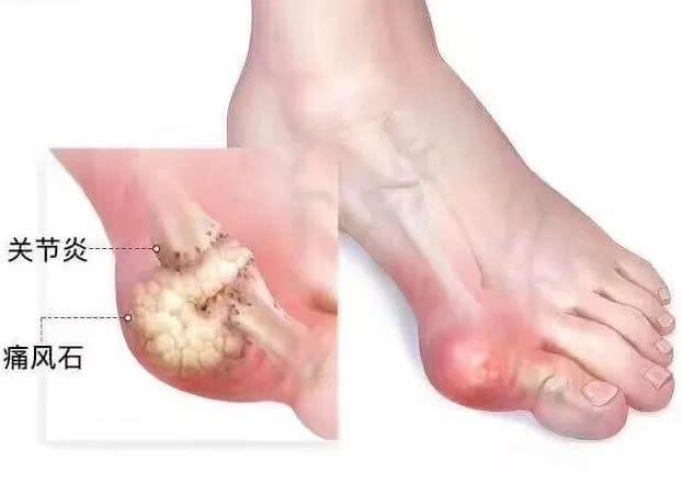 痛风,痛风石,尿酸,膝关节,超声诊断