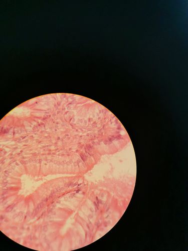 单层柱状上皮胆囊