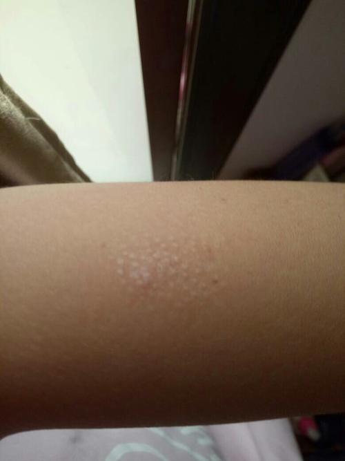 身上好多处长了密密麻麻的小疹子,像鸡皮疙瘩一样,这是什么东西啊?