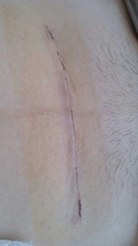 [2014年4月妈妈帮]剖腹产疤痕开始痒了,大家用什么除疤的吗?