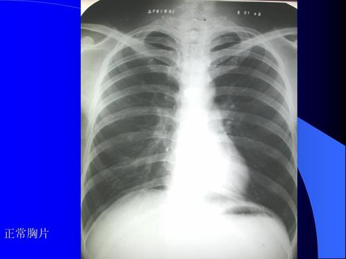 影像学-肺部疾病1ppt