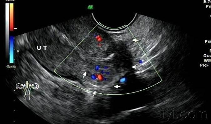 刚出炉的"子宫穿孔"1个
