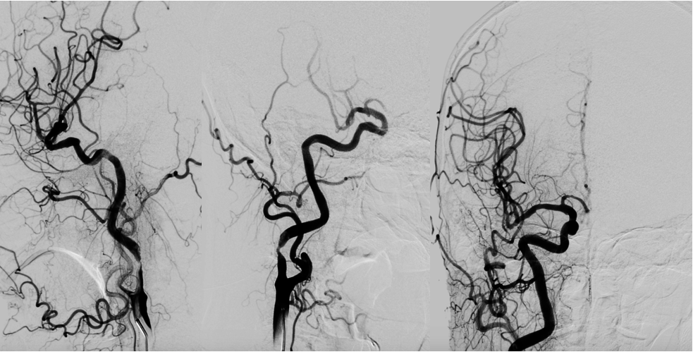 dsa造影: 右侧颈总动脉双侧斜位及正位造影