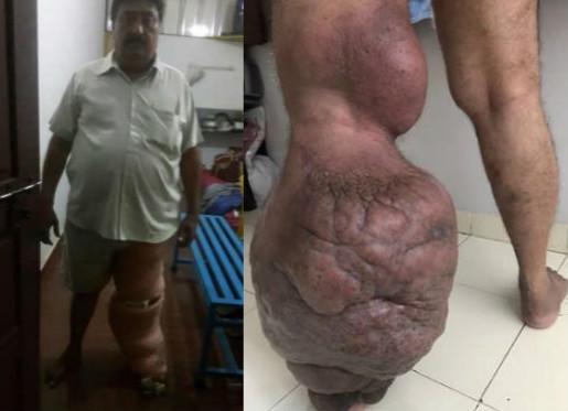 印男子被蚊子叮咬患巨腿病 左腿是正常四倍大