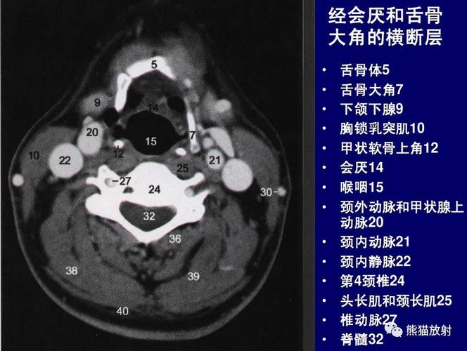 【颈部解剖】筋膜及筋膜间隙,断层解剖图谱
